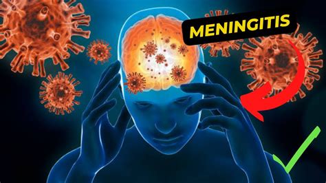 Understanding Meningitis Symptoms Causes Treatment And Prevention