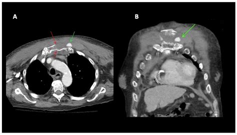 Diagnostics Free Full Text Traumatic Pseudoaneurysms Of The Internal Mammary Artery Two