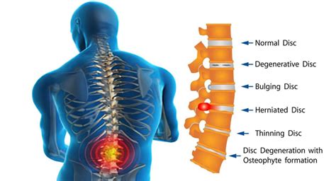 Treatment Of Spondylosis Effective Physiotherapy Clinic Abuja