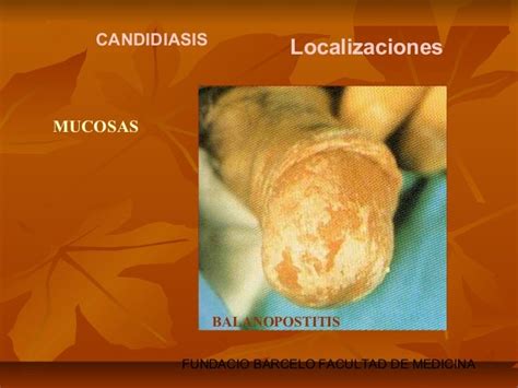 Micosis Superficiales