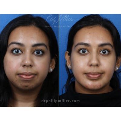 Chin Contouring Gallery | Dr. Philip Miller