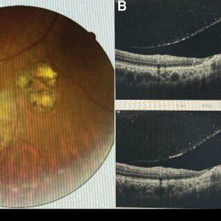 Fundus Photograph And Sd Oct Image Of The Patient A Fundus