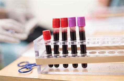 Researchers Identify Biomarkers In Blood To Predict Liver Cancer Mass