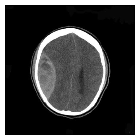 Preop Ct Showing Right Large Epidural Hematoma With Midline Shift