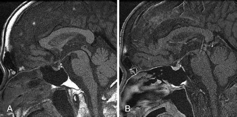 Normal Pituitary Gland Mri