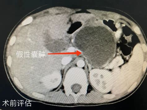 我院完成全腹腔镜下胰腺假性囊肿内引流术 胰腺 患儿 囊肿 假性 手术 健康界