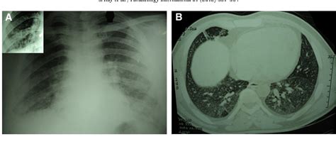 Tropical Pulmonary Eosinophilia Misdiagnosed As Miliary Tuberculosis A