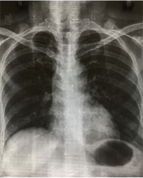 An Erect X Ray Chest Showing No Gas Under Right Dome Of Diaphragm Download Scientific Diagram