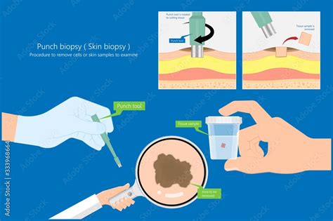 Skin Biopsy Dermoscope Tool Surgical Diagnose Lupus Rash Cell Exam