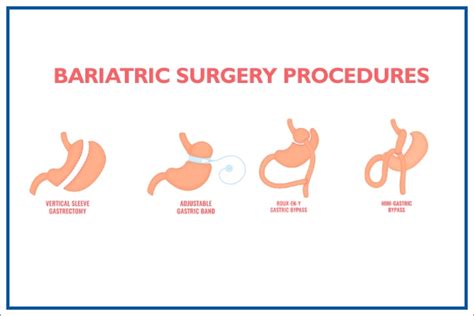 Best Treatment For Bariatric Surgery At Affordable Cost