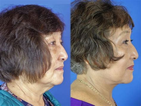 Facelift Reflection Lift Before After Photos Patient Brentwood