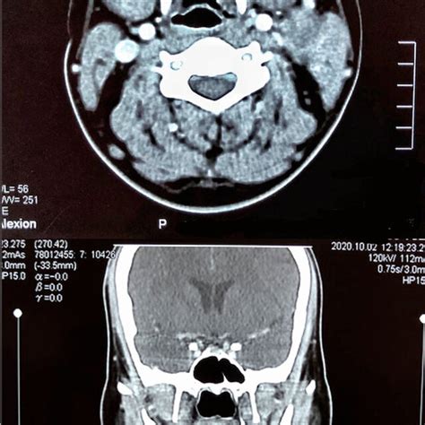 CT scan head and neck with contrast | Download Scientific Diagram