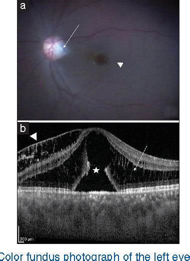 Figure 1 From Surgical Management Of Optic Disc Pit Maculopathy With A Fovea Sparing Internal