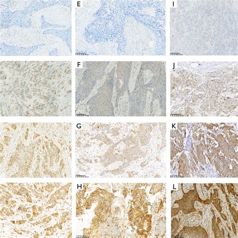 Representative Images Of Immunohistochemical Staining For Vegf C