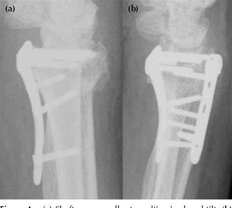 Figure 1 From Mechanical Failure Of The Distal Radius Volar Locking