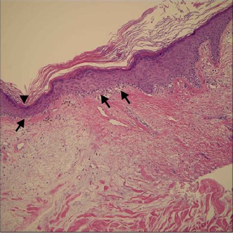 Microscopic Findings Of The Skin Lesion The Biopsy Specimen Shows