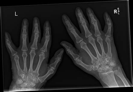 Gouty arthritis of the hands | Image | Radiopaedia.org