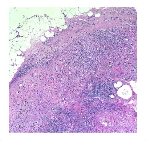 Hematoxylin And Eosin Stained Slide Of Metastatic Axillary Lymph Node