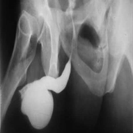 Ascending Urethrography Showed A Diverticulum In The Penile Urethra