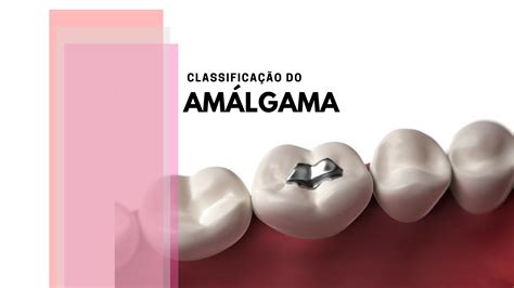 Tudo O Que Você Precisa Saber Sobre Classificação do Amálgama Odonto Up