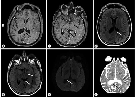 Pretreatment Brain Magnetic Resonance Images A B Cortical Gyriform
