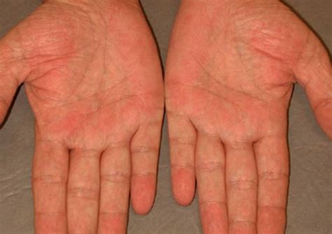 Palmar Erythema Pictures Causes Treatment 2018 Updated