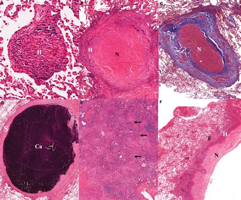 A Early Non Necrotizing Granuloma The Lymphocyte Rim L Appears Download Scientific Diagram