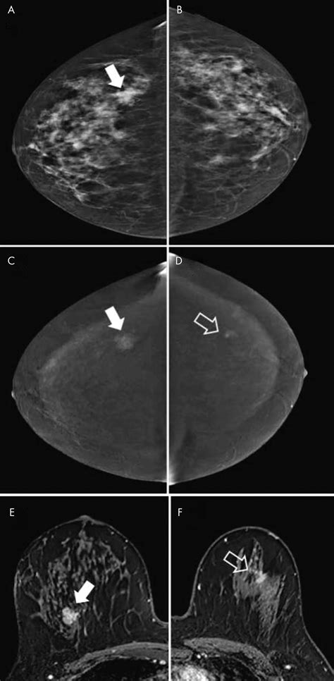 Contrast Enhanced Mammography State Of The Art Radiology