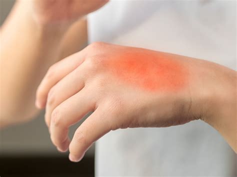 How To Treat A Second Degree Burn At Home Prepared Hero