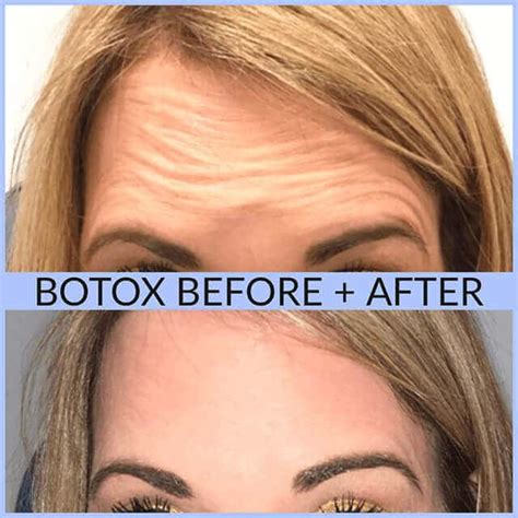 Botox Long Island Botox Before And After Schlessinger Eye