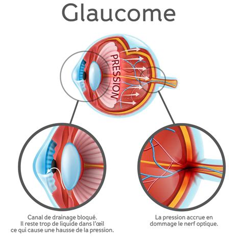 Glaucome Sant Oculaire Voir Les Possibilit S