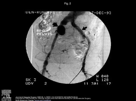 Contemporary Management Of Isolated Iliac Aneurysms Ppt Download