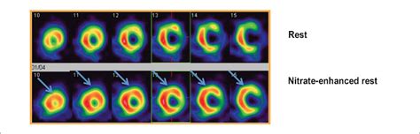 Scielo Brasil Practical Implications Of Myocardial Viability