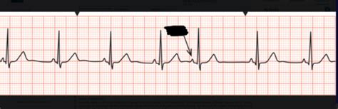 Ekg Strips Flashcards Quizlet