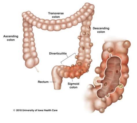 Laparoscopic Colon Surgery Diverticulitis Colon Cancer Los Angeles Encino Tarzana