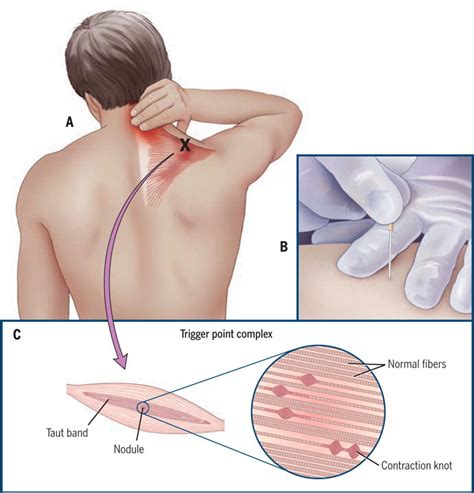 Differences Between Dry Needling And Acupuncture Physiotherapy