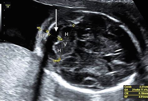 Septo Optic Dysplasia Ultrasound