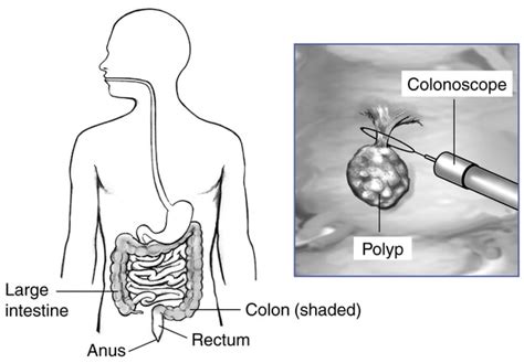 Digestive Tract With Labels An Inset Showing A Colonoscope Removing A