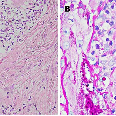 Histologic Examination Of The Skin Lesion Demonstrated Diffuse