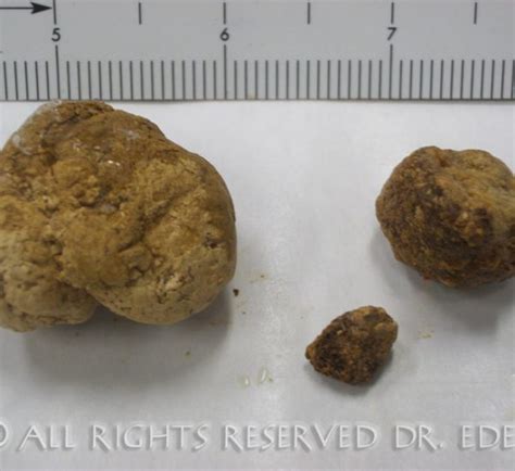 Gallstone Pictures Gallery See Images Of Real Gallstones Passed