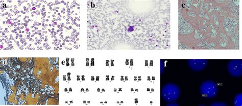 a Peripheral blood film exhibits teardrop cells, basophil, and left ...