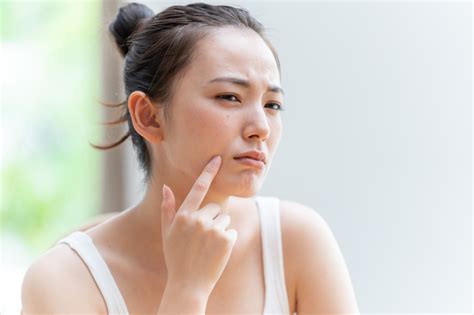 ｢ニキビができやすい人｣の体質を医師が解説 大人ニキビ･吹き出物予防のための体質改善法･スキンケアとは メディカルドック