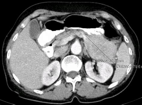 Ct Scan Image Of The Abdomen Highlighting At Pancreas Tail The