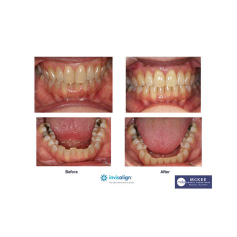 Top 80 Imagen Invisalign Express Abzlocal Fi