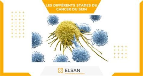 La Classification Et Les Diff Rents Stades Du Cancer Du Sein Institut