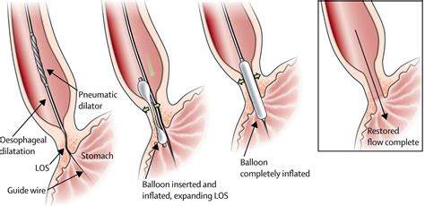 Achalasia - Causes, Symptoms, Types, Diet, Surgery, Treatment