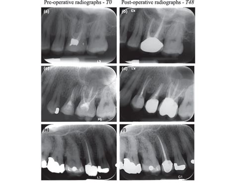 Selected Periapical Radiographs Taken At T And T A Preoperative