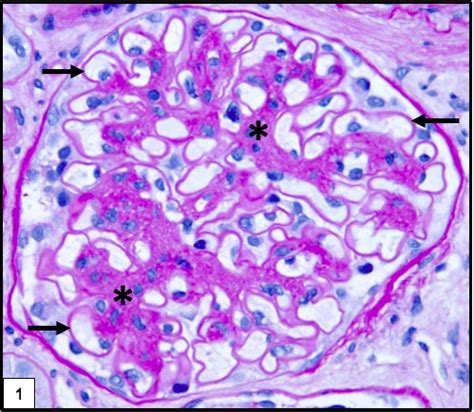 Kidney Biopsy Of The Month Diabetic Nephropathy Renal Fellow Network