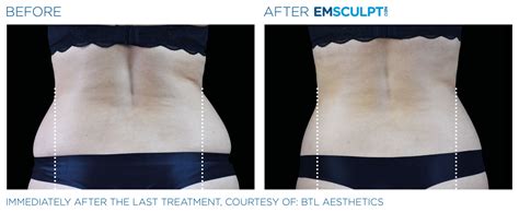 Emsculpt Neo Dr Scott Laker Michigan Surgery