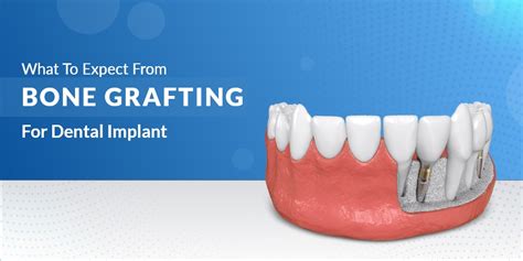 What To Expect From Bone Grafting For Dental Implant La Dental Clinic